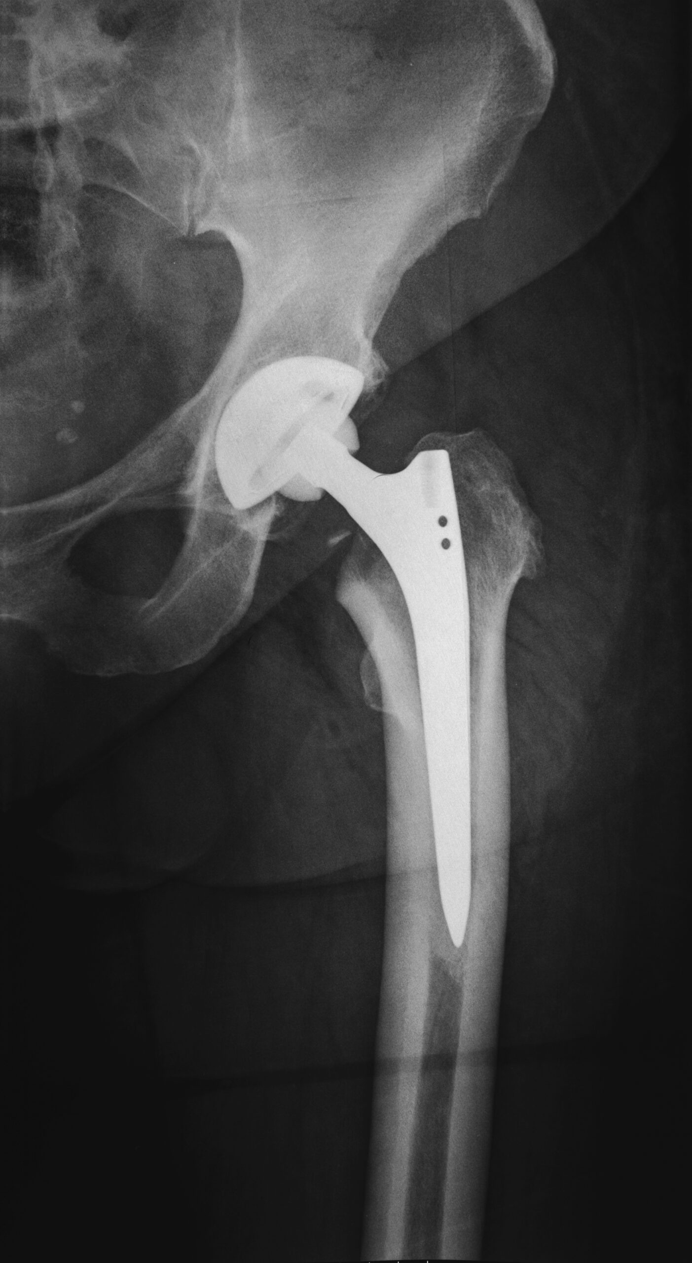 x-ray of artificial hip implant