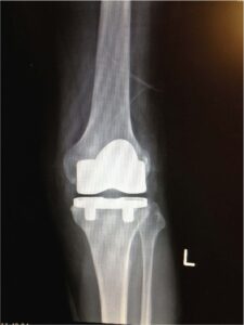 Persona Knee Xray