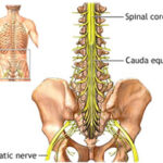 cauda-equina-syndrome