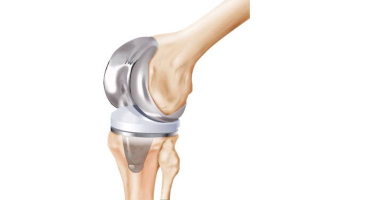 illustration of a total knee replacement