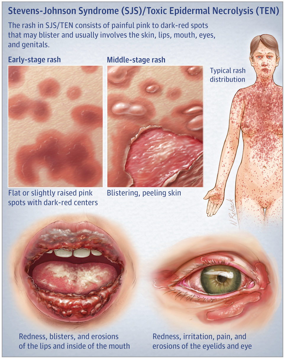 stevens-johnson-syndrome body chart