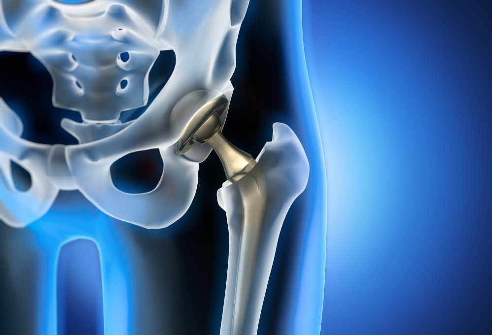 3d rendering of total hip replacement