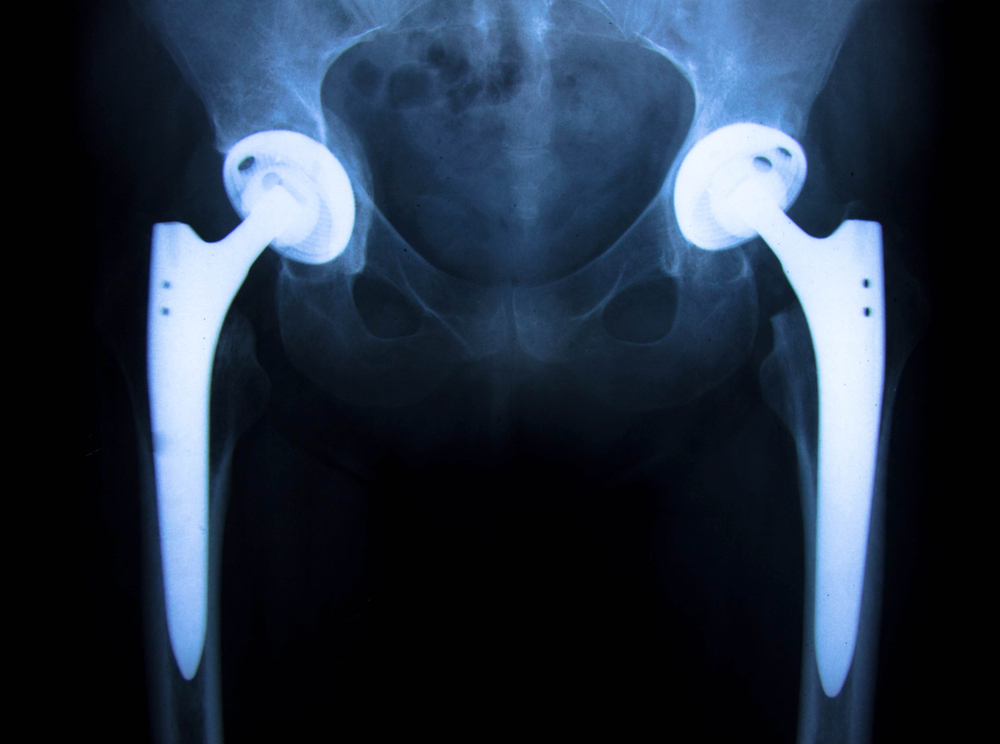 x-ray of total hip replacement