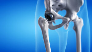 3d rendered medically accurate illustration of a hip replacement