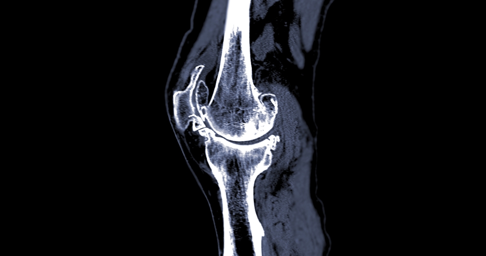 ct bone scan of knee joint