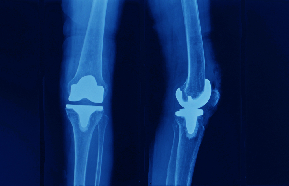 anteroposterior and lateral knee x-ray show total knee replacement or arthroplasty