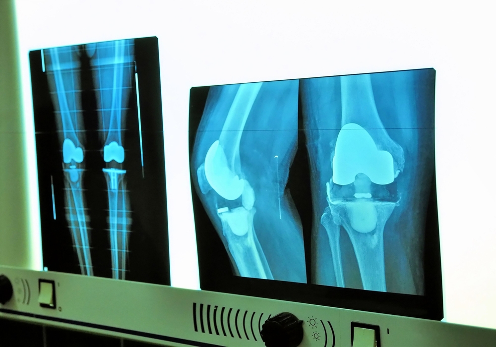 x-ray of total knee replacement after surgery with aseptic loosening