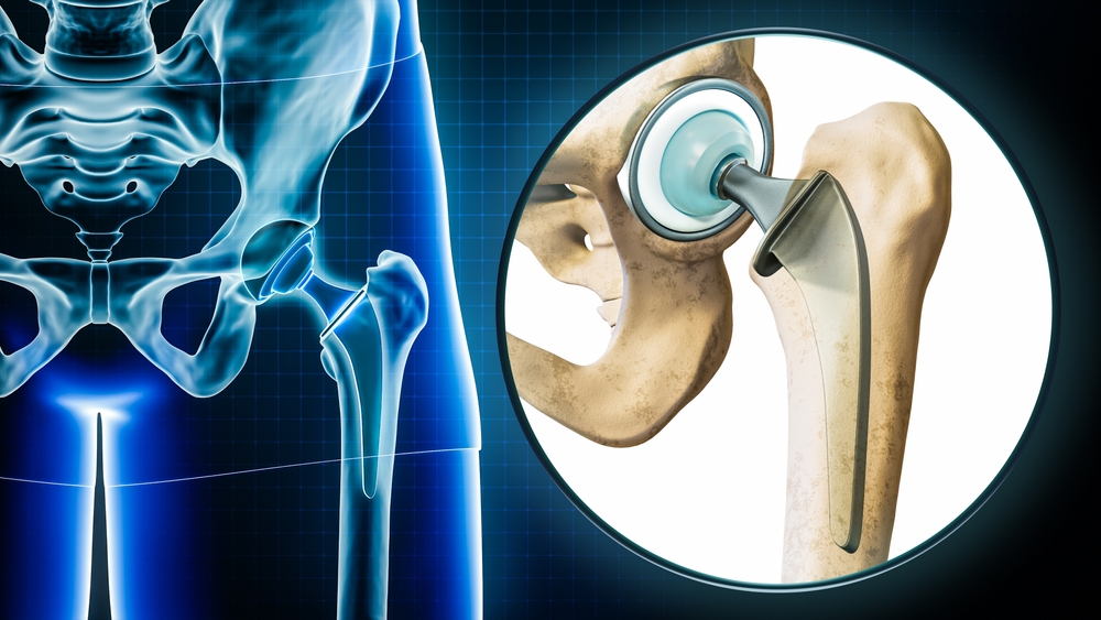 3D rendering of an x-ray of a total hip replacement