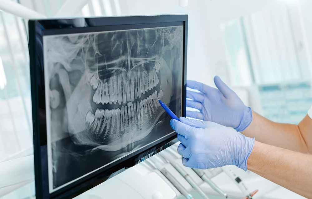 dentist pointing to x-ray-in clinic showing tooth decay