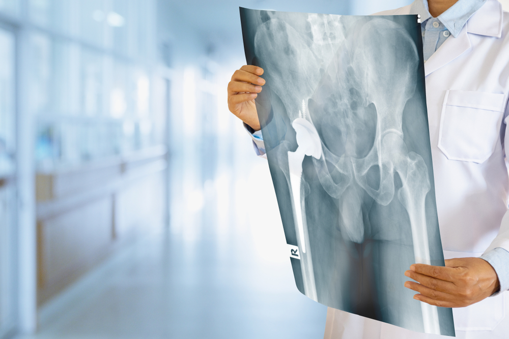 Doctor looking at total hip replacement X-ray film with blurred hospital background.